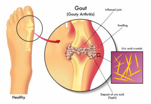 Diagram comparing healthy to with gouty toe