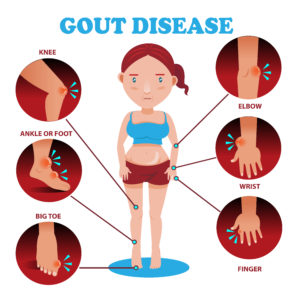 Sketch showing joints susceptible to gout