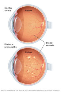 Illustration comparing good eye to eye with diabetic retinopathy